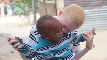 Afrikalı albinolar 'beyaz' bir gelecek ümidiyle yaşıyor